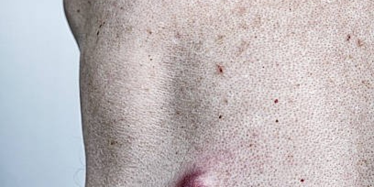 Can an Infected Cyst Cost More to Treat?
