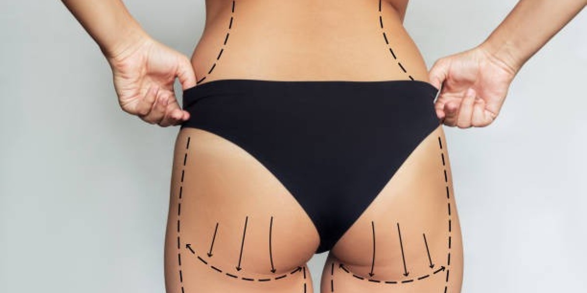 Thigh Lift Aftercare: Guidance for Riyadh Patients