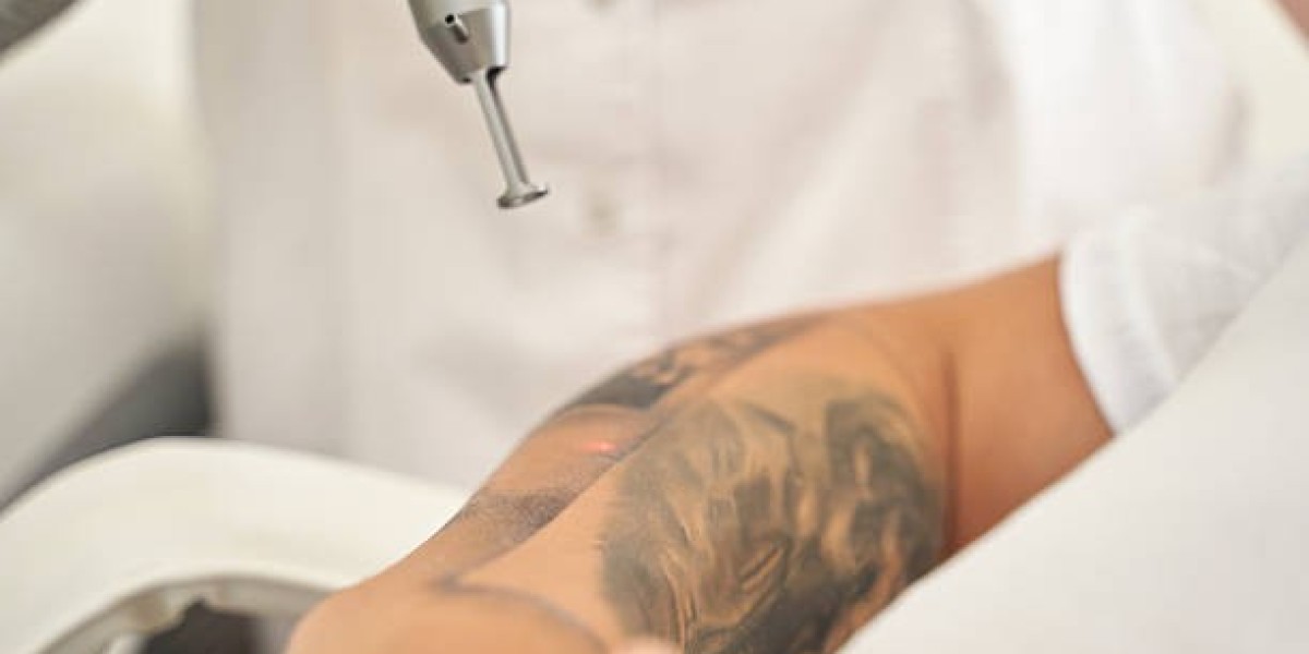 Removing Cosmetic Tattoos: What to Know