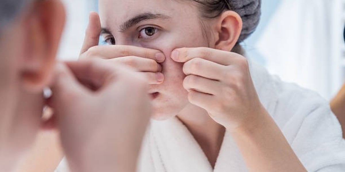 What to Expect During Acne Treatment