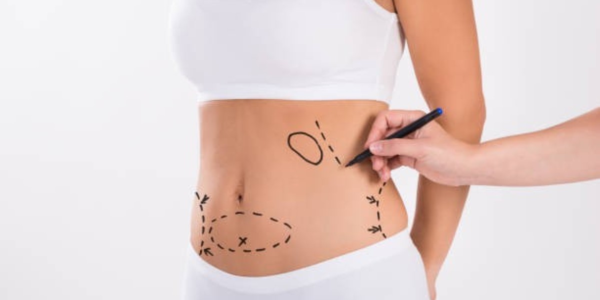 Liposuction in Riyadh for Lower Abdomen Fat Reduction