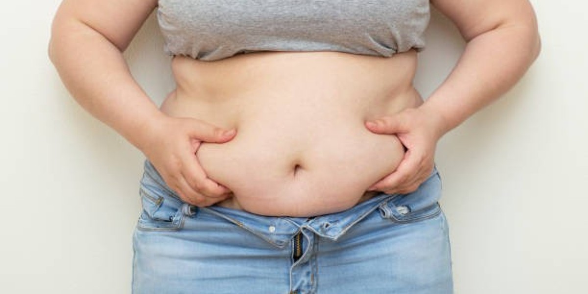 My Experience With Tummy Tuck Surgery: Setting Realistic Goals