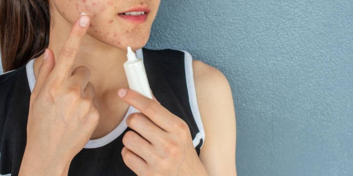 Can Facial Treatments Help Acne-Prone Skin?