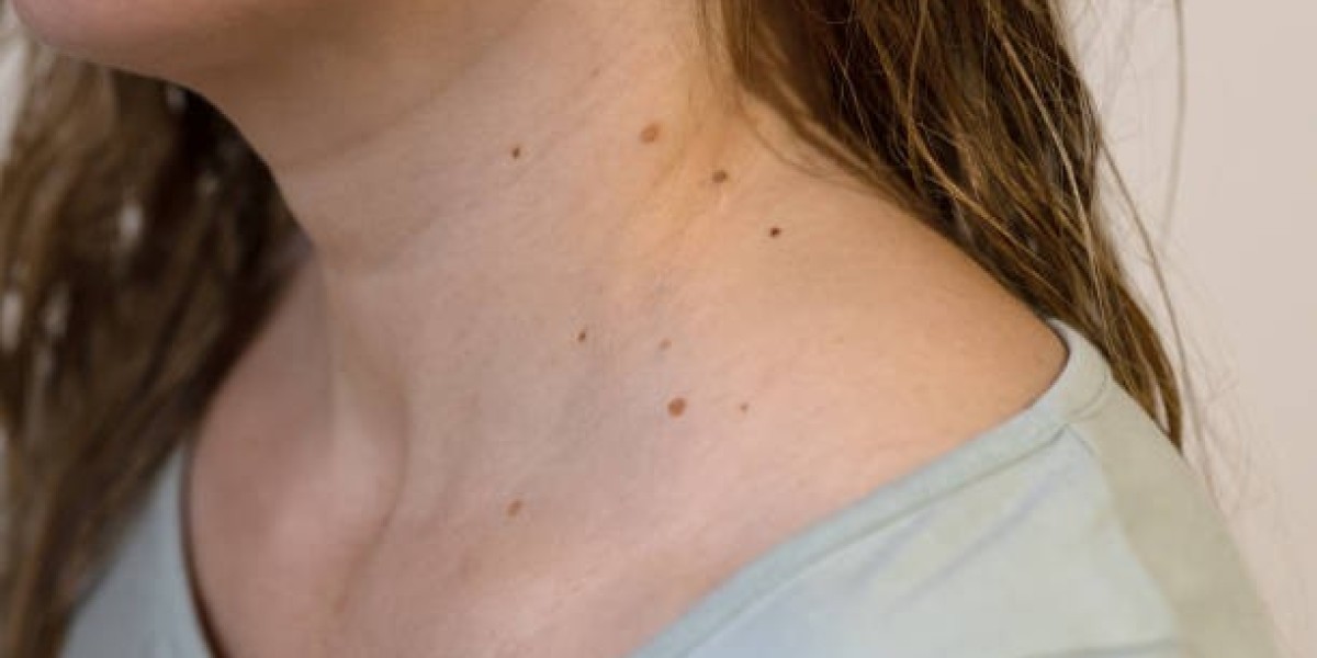 Mole Removal and Scarring: Prevention, Care, and Recovery Tips