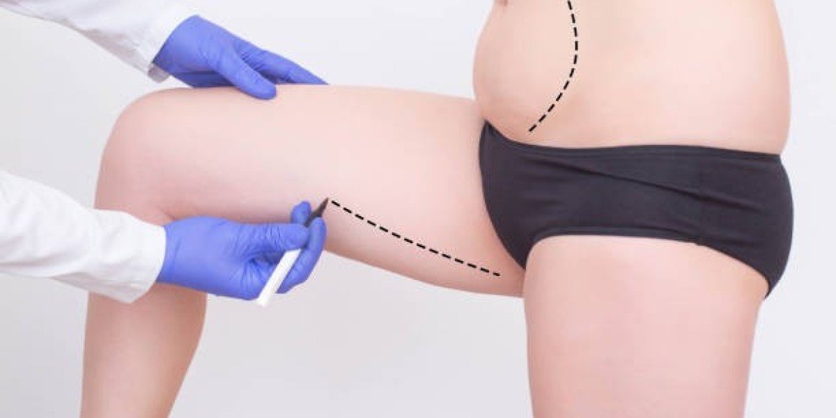 Liposuction in Riyadh: Exploring Safe Approaches to Fat Reduction