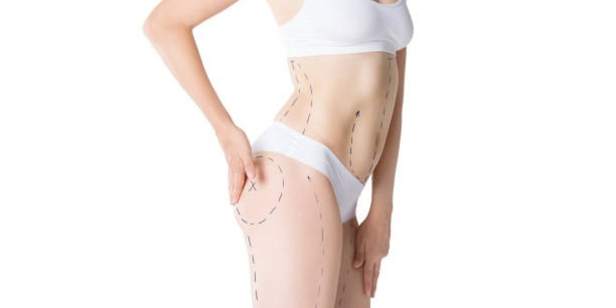 Liposuction Safety and Patient Considerations